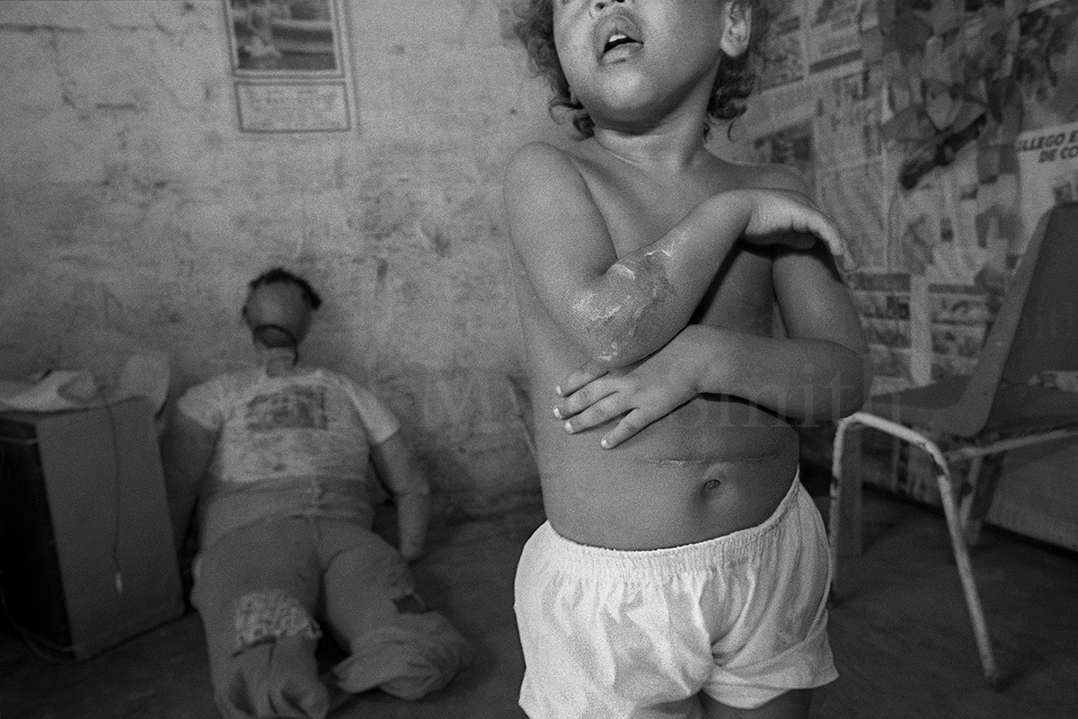 Young girl shows scars left by hand grenade shrapnel